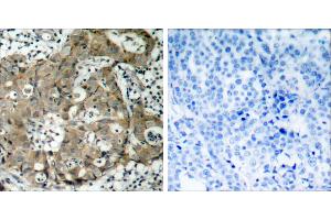 Peptide - +Immunohistochemical analysis of paraffin-embedded human breast carcinoma tissue using FKHR (Ab-319) antibody (#B7086). (FOXO1 抗体  (Ser319))