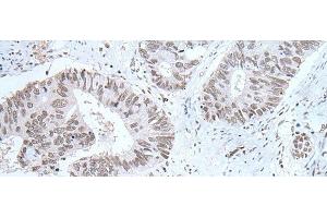Immunohistochemistry of paraffin-embedded Human colorectal cancer tissue using HCRT Polyclonal Antibody at dilution of 1:25(x200) (Orexin 抗体)