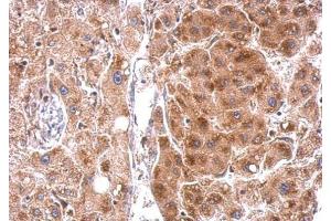 IHC-P Image StAR antibody detects StAR protein at cytosol on human hepatoma by immunohistochemical analysis. (STAR 抗体)