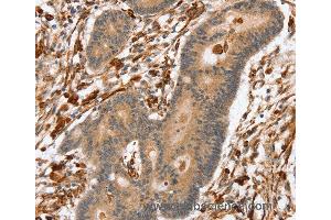 Immunohistochemistry of Human colon cancer using SSX2IP Polyclonal Antibody at dilution of 1:45