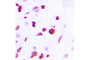 Immunohistochemical analysis of C/EBP beta staining in human lung cancer formalin fixed paraffin embedded tissue section. (CEBPB 抗体  (C-Term))