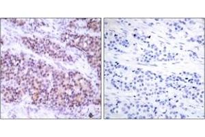 Immunohistochemistry analysis of paraffin-embedded human breast carcinoma, using BCL-XL (Phospho-Ser62) Antibody.