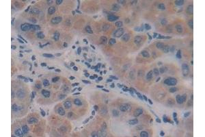 Detection of AFP in Human Liver cancer Tissue using Polyclonal Antibody to Alpha-Fetoprotein (AFP) (alpha Fetoprotein 抗体  (AA 31-171))