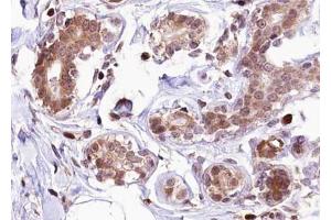 ABIN6267278 at 1/100 staining human Breast carcinoma tissue sections by IHC-P. (Estrogen Receptor alpha 抗体  (pSer118))