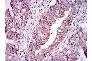 Immunohistochemical analysis of paraffin-embedded rectum cancer tissues using ITGA2B mouse mAb with DAB staining. (Integrin Alpha2b 抗体  (AA 45-149))