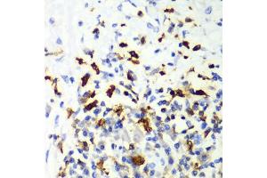 Immunohistochemistry of paraffin-embedded human liver cancer using CAPG Antibody (ABIN6132242, ABIN6137908, ABIN6137909 and ABIN7101810) at dilution of 1:100 (40x lens). (CAPG 抗体  (AA 1-348))