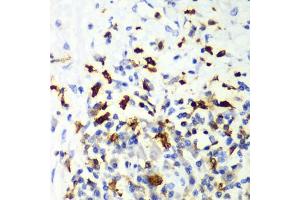 Immunohistochemistry of paraffin-embedded human liver cancer using CAPG Antibody (ABIN6132242, ABIN6137908, ABIN6137909 and ABIN7101810) at dilution of 1:100 (40x lens). (CAPG 抗体  (AA 1-348))