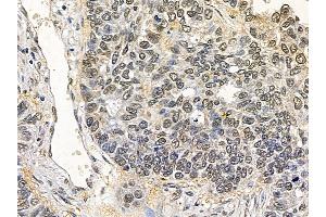 ABIN7094277 and ABIN7098324 at 1/100 staining human lung cancer and adjacent non-tumor tissue by IHC-P.