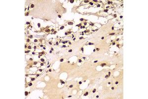 Immunohistochemistry of paraffin-embedded human kidney cancer using ZNF20 antibody at dilution of 1:100 (x400 lens). (ZNF20 抗体)