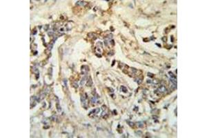 Immunohistochemistry analysis in breast carcinoma (Formalin-fixed, Paraffin-embedded) using MRAP Antibody (N-term), followed by peroxidase conjugated secondary antibody and DAB staining. (MRAP 抗体  (N-Term))