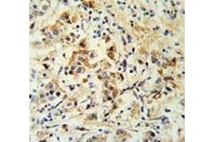 Bid antibody IHC analysis in formalin fixed and paraffin embedded human breast carcinoma. (BID 抗体  (AA 39-68))