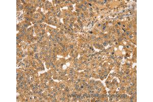 Immunohistochemistry of Human breast cancer using STX10 Polyclonal Antibody at dilution of 1:35 (Syntaxin 10 抗体)