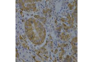 Immunohistochemistry of paraffin-embedded human gastric cancer using BIN1 Antibody (ABIN3022553, ABIN3022554, ABIN1678863 and ABIN6218901) at dilution of 1:200 (40x lens). (BIN1 抗体  (AA 230-409))