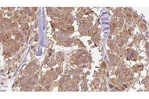 ABIN6274897 at 1/100 staining Human Melanoma tissue by IHC-P. (EPB41L2 抗体  (Internal Region))