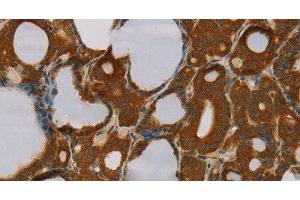 Immunohistochemistry of paraffin-embedded Human thyroid cancer tissue using PARP3 Polyclonal Antibody at dilution 1:40 (PARP3 抗体)