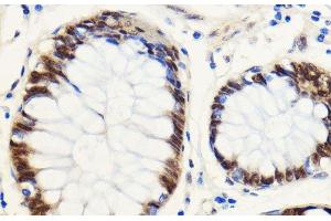 Immunohistochemistry of paraffin-embedded Human colon carcinoma using SNIP1 Polyclonal Antibody at dilution of 1:100 (40x lens). (SNIP1 抗体)