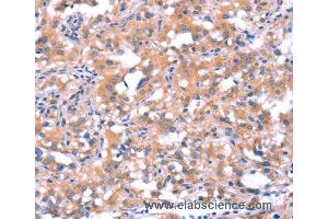Immunohistochemistry of Human thyroid cancer using FAT1 Polyclonal Antibody at dilution of 1:40 (FAT1 抗体)