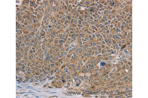 Immunohistochemistry of Human ovarian cancer using NDUFS7 Polyclonal Antibody at dilution of 1:40 (NDUFS7 抗体)