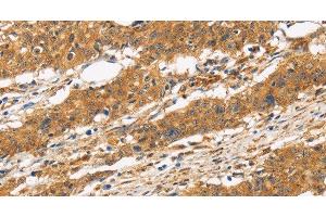 Immunohistochemistry of paraffin-embedded Human gasrtic cancer tissue using CD22 Polyclonal Antibody at dilution 1:50 (CD22 抗体)