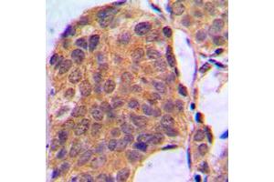 Immunohistochemical analysis of ERK1/2 staining in human breast cancer formalin fixed paraffin embedded tissue section. (ERK1/2 抗体  (C-Term))