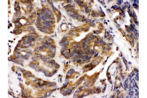 Talin 2 was detected in paraffin-embedded sections of human intestinal cancer tissues using rabbit anti- Talin 2 Antigen Affinity purified polyclonal antibody (Catalog # ) at 1 µg/mL. (TLN2 抗体  (Middle Region))