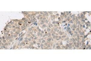 Immunohistochemistry of paraffin-embedded Human ovarian cancer tissue using ZNF449 Polyclonal Antibody at dilution of 1:50(x200) (ZNF449 抗体)