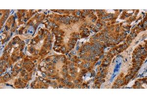 Immunohistochemistry of paraffin-embedded Human thyroid cancer tissue using MBNL3 Polyclonal Antibody at dilution 1:30 (MBNL3 抗体)