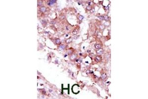 Formalin-fixed and paraffin-embedded human cancer tissue reacted with the primary antibody, which was peroxidase-conjugated to the secondary antibody, followed by DAB staining. (STK33 抗体  (C-Term))