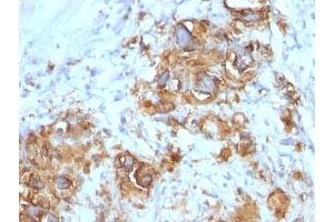 Formalin-fixed, paraffin-embedded human gastric carcinoma stained with CA19-9 antibody (121SLE). (CA 19-9 抗体)
