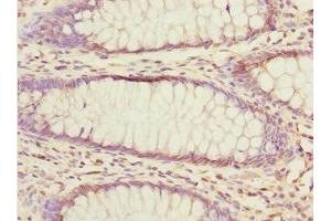 Immunohistochemistry of paraffin-embedded human colon cancer using ABIN7152363 at dilution of 1:100 (EYA3 抗体  (AA 1-300))