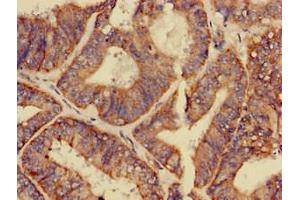 Immunohistochemistry of paraffin-embedded human endometrial cancer using ABIN7154155 at dilution of 1:100 (GPAM 抗体  (AA 281-459))
