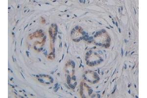 Detection of GPLD1 in Human Pancreatic cancer Tissue using Polyclonal Antibody to Glycosylphosphatidylinositol Specific Phospholipase D1 (GPLD1) (GPLD1 抗体  (AA 496-840))