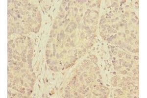 Immunohistochemistry of paraffin-embedded human ovarian cancer using ABIN7173139 at dilution of 1:100 (FAM156A 抗体  (AA 251-519))