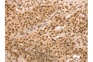 The image on the left is immunohistochemistry of paraffin-embedded Human breast cancer tissue using ABIN7131133(SNX8 Antibody) at dilution 1/25, on the right is treated with fusion protein. (SNX8 抗体)