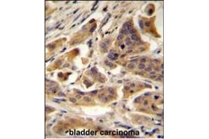 RBCK1 (UBCE7IP3) Antibody (N-term) A immunohistochemistry analysis in formalin fixed and paraffin embedded human bladder carcinoma followed by peroxidase conjugation of the secondary antibody and DAB staining. (RBCK1 抗体  (N-Term))