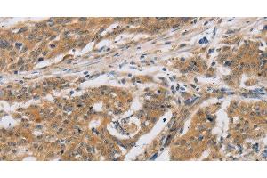 Immunohistochemistry of paraffin-embedded Human ovarian cancer tissue using CST6 Polyclonal Antibody at dilution 1:30 (CST6 抗体)
