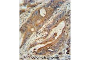 ZBBX antibody (N-term) immunohistochemistry analysis in formalin fixed and paraffin embedded human colon carcinoma followed by peroxidase conjugation of the secondary antibody and DAB staining. (ZBBX 抗体  (N-Term))
