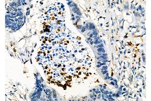 ABIN6261740 and ABIN6278462 at 1/100 staining Human colorectal cancer by IHC-P. (FGL2 抗体  (C-Term))