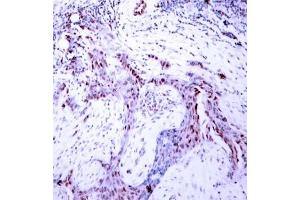 Immunohistochemical analysis of paraffin- embedded human breast carcinoma tissue, using Progesterone Receptor (phospho-Ser190) antibody (E011074). (Progesterone Receptor 抗体  (pSer190))
