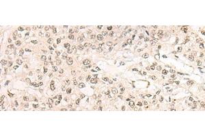 Immunohistochemistry of paraffin-embedded Human prost ate cancer tissue using WEE1 Polyclonal Antibody at dilution of 1:35(x200)