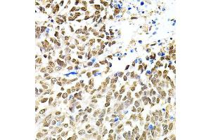 Immunohistochemistry of paraffin-embedded human lung cancer using PNKP antibody (ABIN2564598) at dilution of 1:100 (40x lens). (PNKP 抗体)