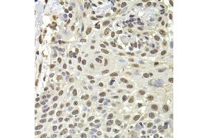 Immunohistochemistry of paraffin-embedded human well-differentiated squamous skin carcinoma using PUF60 antibody (ABIN5974052) at dilution of 1/100 (40x lens). (PUF60 抗体)