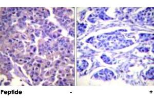 Immunohistochemical analysis of paraffin-embedded human breast carcinoma tissue using CALD1 polyclonal antibody .