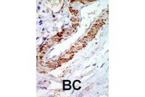 Formalin-fixed and paraffin-embedded human cancer tissue reacted with the MAP3K8 polyclonal antibody  , which was peroxidase-conjugated to the secondary antibody, followed by DAB staining.