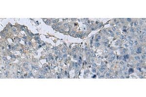 Immunohistochemistry of paraffin-embedded Human liver cancer tissue using GLS Polyclonal Antibody at dilution of 1:70(x200) (Glutaminase 抗体)