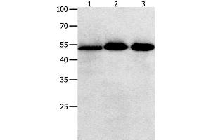 Western Blot analysis of Human lymphoma , ovarian and colon cancer tissue using KLF5 Polyclonal Antibody at dilution of 1:350 (KLF5 抗体)