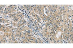 Immunohistochemistry of paraffin-embedded Human gasrtic cancer tissue using PKD1 Polyclonal Antibody at dilution 1:40 (PKD1 抗体)
