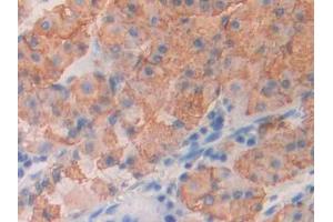 DAB staining on IHC-P; Samples: Human Stomach cancer Tissue (ICOS 抗体  (AA 31-190))