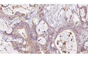ABIN6267476 at 1/100 staining Human liver cancer tissue by IHC-P. (Cadherin 5 抗体  (pTyr731))