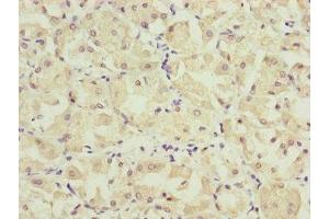 Immunohistochemistry of paraffin-embedded human gastric cancer using ABIN7157234 at dilution of 1:100 (KANSL3 抗体  (AA 1-200))